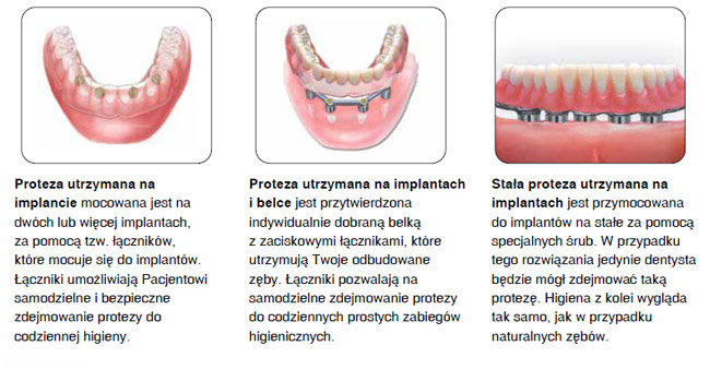 rodzaje implantów dentystycznych